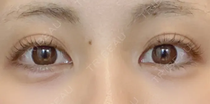 ヒアルロン酸注入（涙袋） フィラークリニック 新宿院 AFTER メイン用