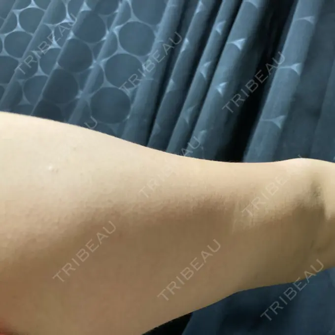 脂肪吸引（二の腕） 湘南美容クリニック 新潟院 DAY 24 メイン用