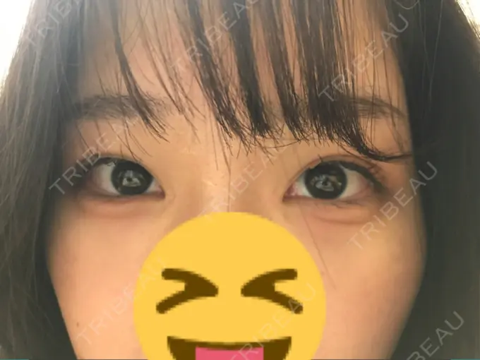 ヒアルロン酸注入（涙袋） フィラークリニック 横浜院 DAY 58 メイン用