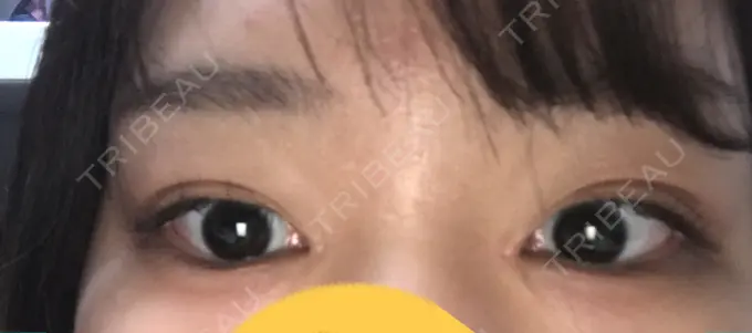 ヒアルロン酸注入（涙袋） フィラークリニック 横浜院 DAY 58 メイン用