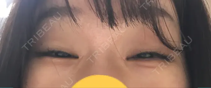 ヒアルロン酸注入（涙袋） フィラークリニック 横浜院 DAY 58 メイン用