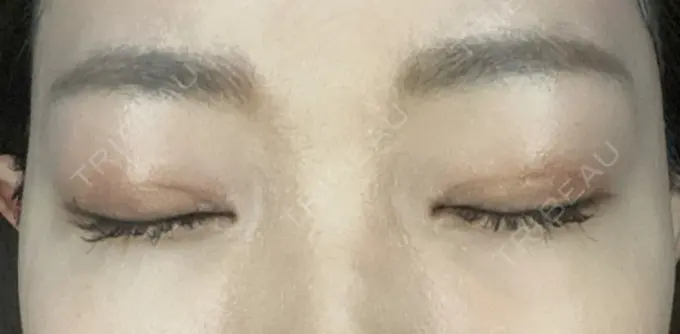 二重切開 / 目頭切開 心斎橋コムロ美容外科クリニック DAY 237 メイン用