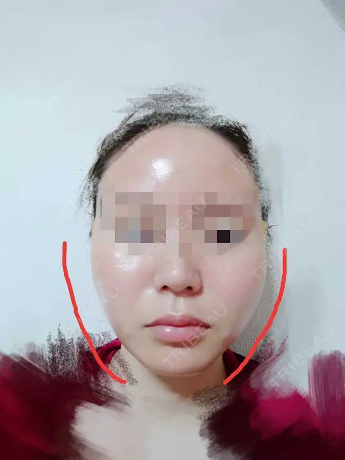 糸リフト TCB東京中央美容外科 八王子院 DAY 0 メイン用