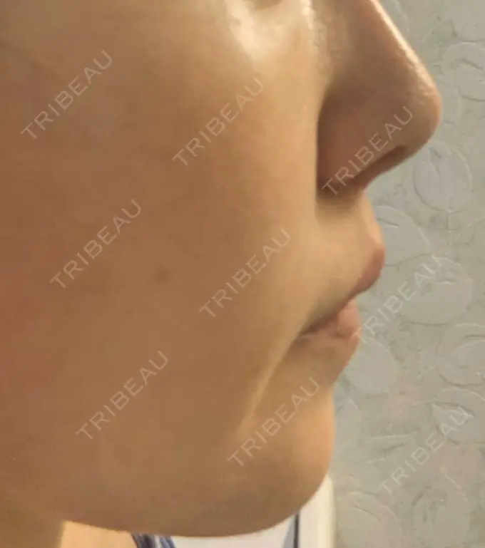 糸リフト / ボトックス（あご） / ヒアルロン酸注入（あご） フローラクリニック DAY 6 メイン用