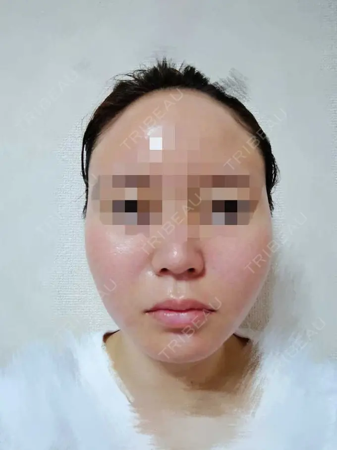 糸リフト TCB東京中央美容外科 八王子院 DAY 1 メイン用