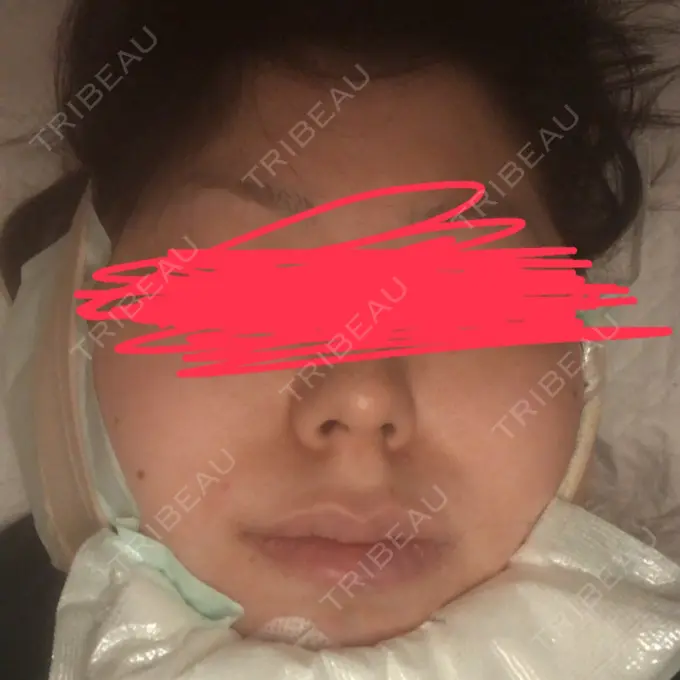 脂肪吸引（顔） THE CLINIC（ザ・クリニック） 福岡院 DAY 0 メイン用