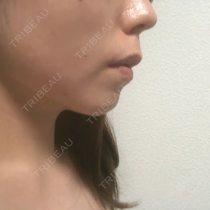 脂肪吸引（顔） THE CLINIC（ザ・クリニック） 福岡院 DAY 1 メイン用