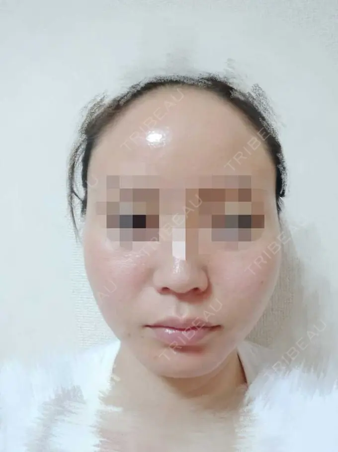 糸リフト TCB東京中央美容外科 八王子院 DAY 2 メイン用