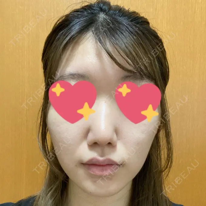 鼻尖形成（切開） / 軟骨移植 麹町皮ふ科・形成外科クリニック DAY 48 メイン用