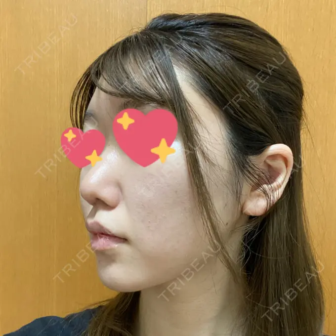 鼻尖形成（切開） / 軟骨移植 麹町皮ふ科・形成外科クリニック DAY 48 メイン用