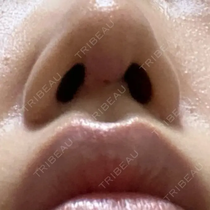 鼻尖形成（切開） / 軟骨移植 麹町皮ふ科・形成外科クリニック DAY 48 メイン用