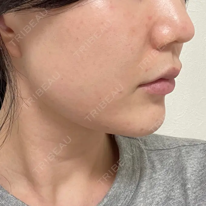 糸リフト / 脂肪吸引（顔） / メーラーファット除去 湘南美容クリニック 秋葉原院 DAY 16 メイン用