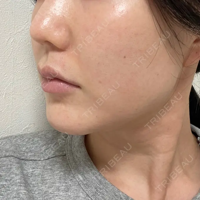 糸リフト / 脂肪吸引（顔） / メーラーファット除去 湘南美容クリニック 秋葉原院 DAY 16 メイン用