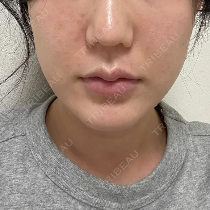 糸リフト / 脂肪吸引（顔） / メーラーファット除去 湘南美容クリニック 秋葉原院 DAY 16 メイン用