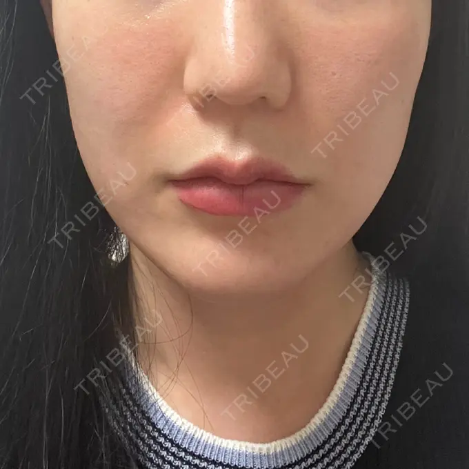 糸リフト / 脂肪吸引（顔） / メーラーファット除去 湘南美容クリニック 秋葉原院 DAY 21 メイン用