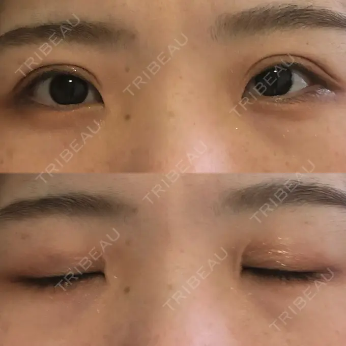 二重切開 城本クリニック 福岡院 AFTER メイン用