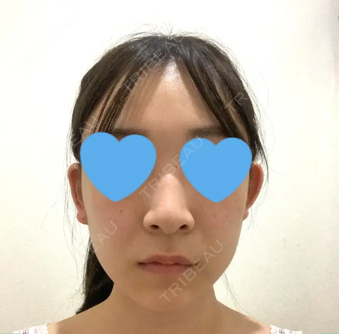 骨切り（あご） / 骨削り（エラ） / 骨削り（頬） / 脂肪吸引（顔） アーククリニック DAY 79 メイン用