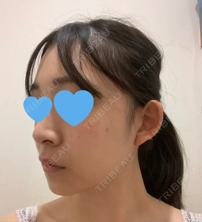 骨切り（あご） / 骨削り（エラ） / 骨削り（頬） / 脂肪吸引（顔） アーククリニック DAY 79 メイン用