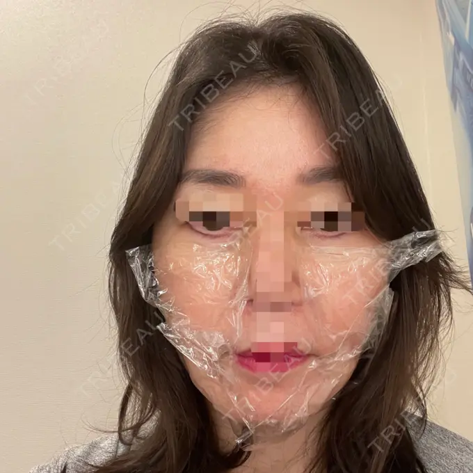 PRP皮膚再生療法 恵聖会クリニック 京橋院 DAY 0 メイン用