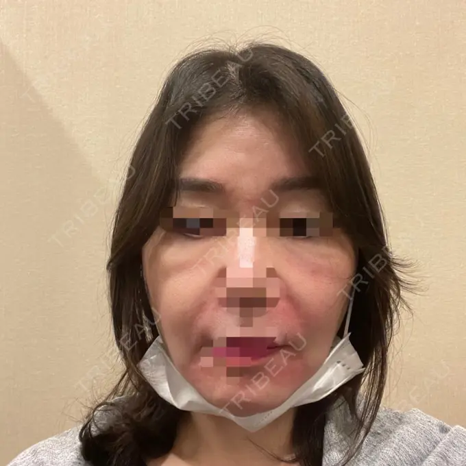 PRP皮膚再生療法 恵聖会クリニック 京橋院 DAY 0 メイン用