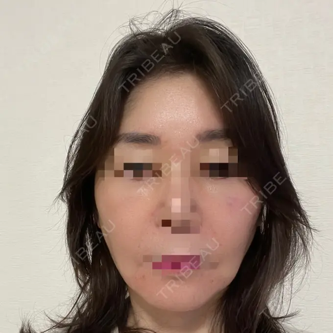 PRP皮膚再生療法 恵聖会クリニック 京橋院 DAY 0 メイン用