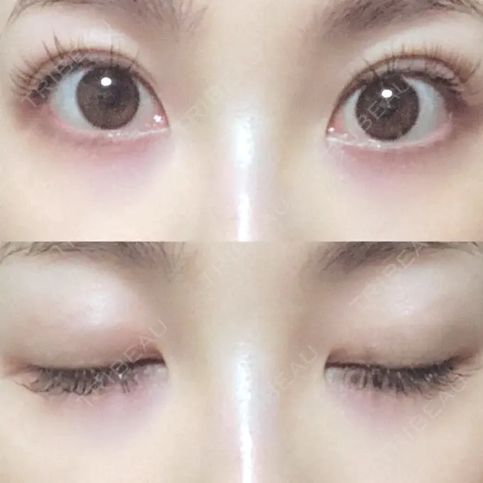 二重埋没 MIL CLINIC OSAKA AFTER メイン用