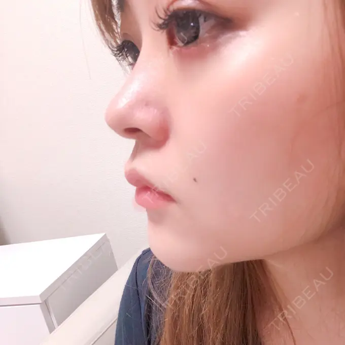 軟骨移植 BIANCA銀座 DAY 276 メイン用