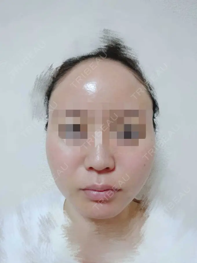 糸リフト TCB東京中央美容外科 八王子院 DAY 3 メイン用