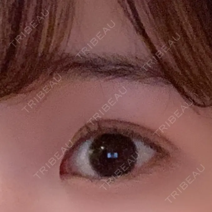 二重埋没 湘南メディカル記念病院（両国） DAY 20 メイン用