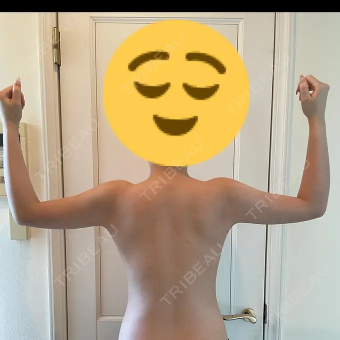 脂肪吸引（二の腕） 湘南美容クリニック 新橋銀座口院 AFTER メイン用