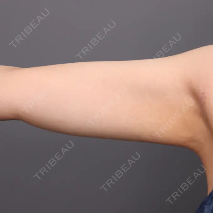 脂肪吸引（二の腕） THE CLINIC（ザ・クリニック） 福岡院 AFTER メイン用