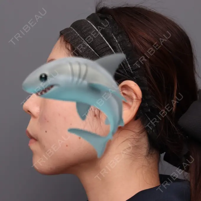 脂肪吸引（顔） THE CLINIC（ザ・クリニック） 福岡院 AFTER メイン用