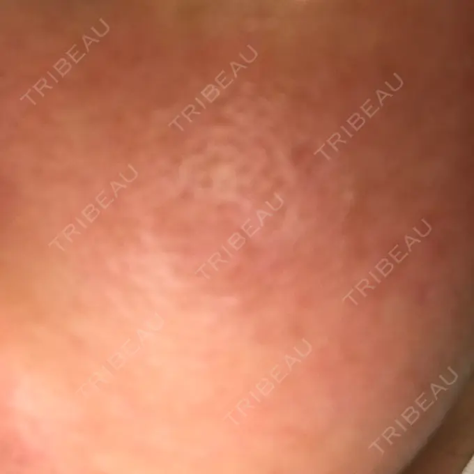 ダーマペン 湘南美容クリニック 武蔵小杉院 DAY 0 メイン用