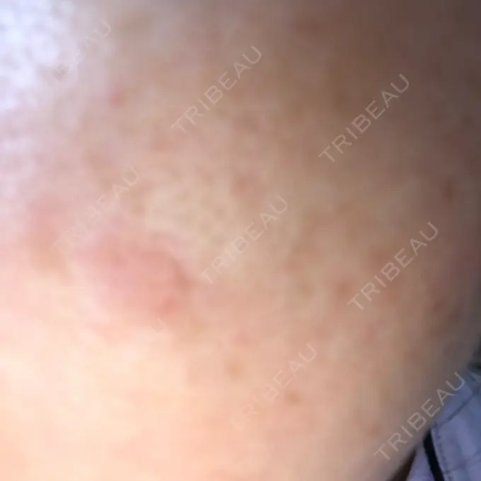 ダーマペン 湘南美容クリニック 武蔵小杉院 DAY 1 メイン用