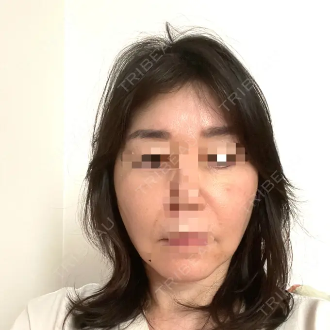 PRP皮膚再生療法 恵聖会クリニック 京橋院 DAY 2 メイン用