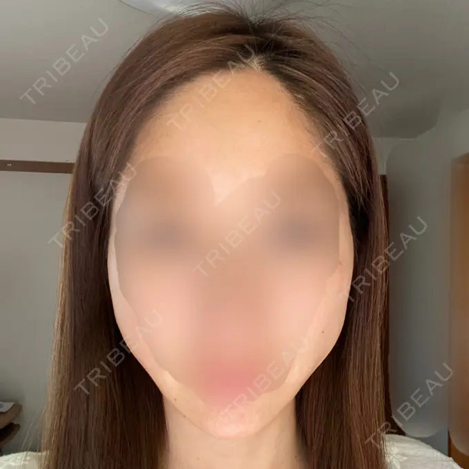 糸リフト / ボトックス（エラ・小顔） TCB東京中央美容外科 立川院 DAY 1 メイン用