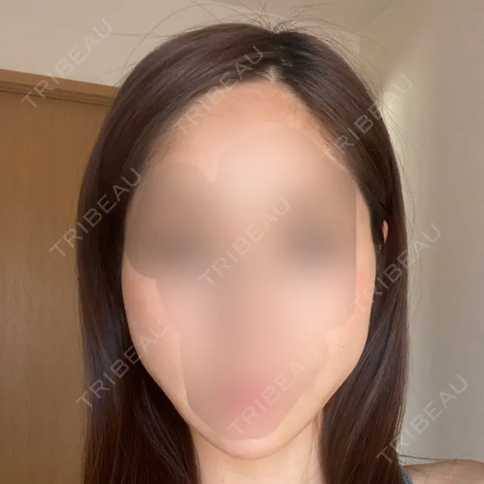 糸リフト / ボトックス（エラ・小顔） TCB東京中央美容外科 立川院 DAY 3 メイン用