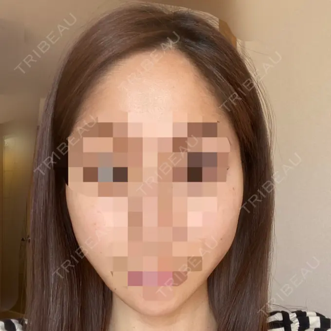 糸リフト / ボトックス（エラ・小顔） TCB東京中央美容外科 立川院 AFTER メイン用