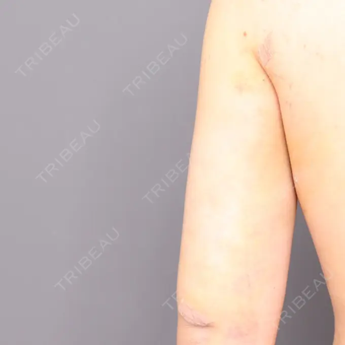 脂肪吸引（二の腕） THE CLINIC（ザ・クリニック） 福岡院 DAY 3 メイン用