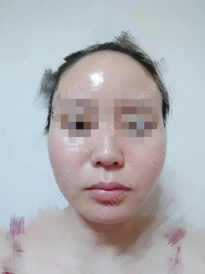 糸リフト TCB東京中央美容外科 八王子院 DAY 5 メイン用