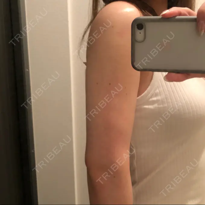 脂肪吸引（二の腕） THE CLINIC（ザ・クリニック） 福岡院 DAY 21 メイン用