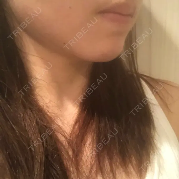 脂肪吸引（顔） THE CLINIC（ザ・クリニック） 福岡院 DAY 3 メイン用