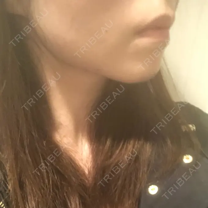 脂肪吸引（顔） THE CLINIC（ザ・クリニック） 福岡院 DAY 7 メイン用