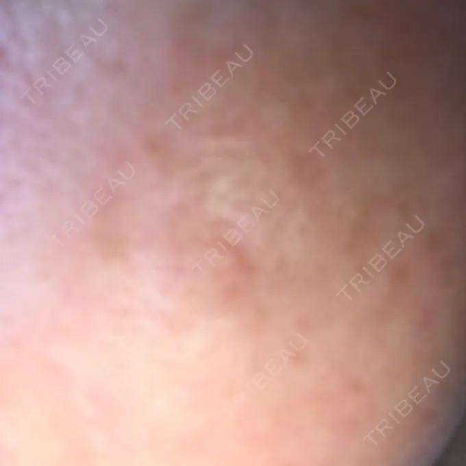 ダーマペン 湘南美容クリニック 武蔵小杉院 DAY 2 メイン用