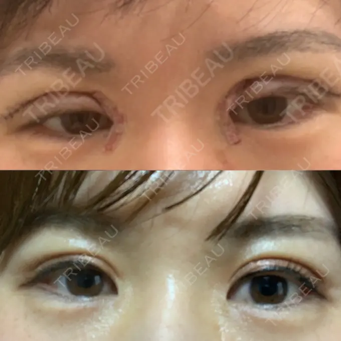 二重切開 / 目頭切開 / 上まぶたの脂肪取り 品川スキンクリニック岡山院 DAY 499 メイン用