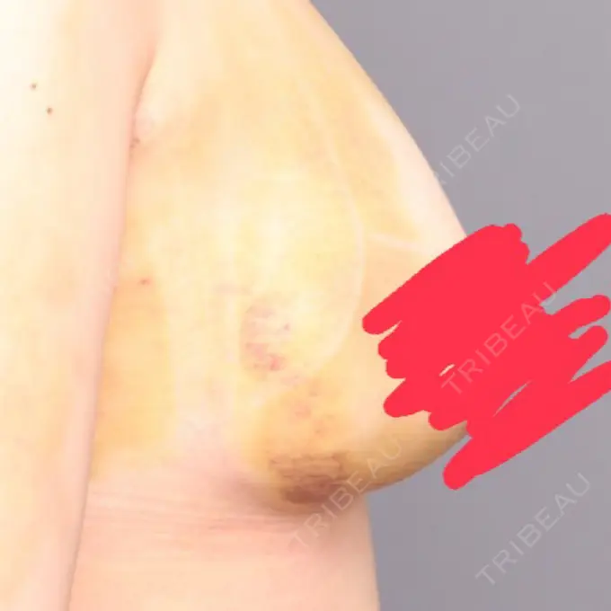 豊胸（脂肪注入） THE CLINIC（ザ・クリニック） 福岡院 DAY 2 メイン用