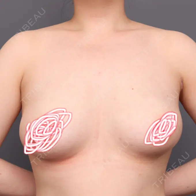 豊胸（脂肪注入） THE CLINIC（ザ・クリニック） 福岡院 AFTER メイン用