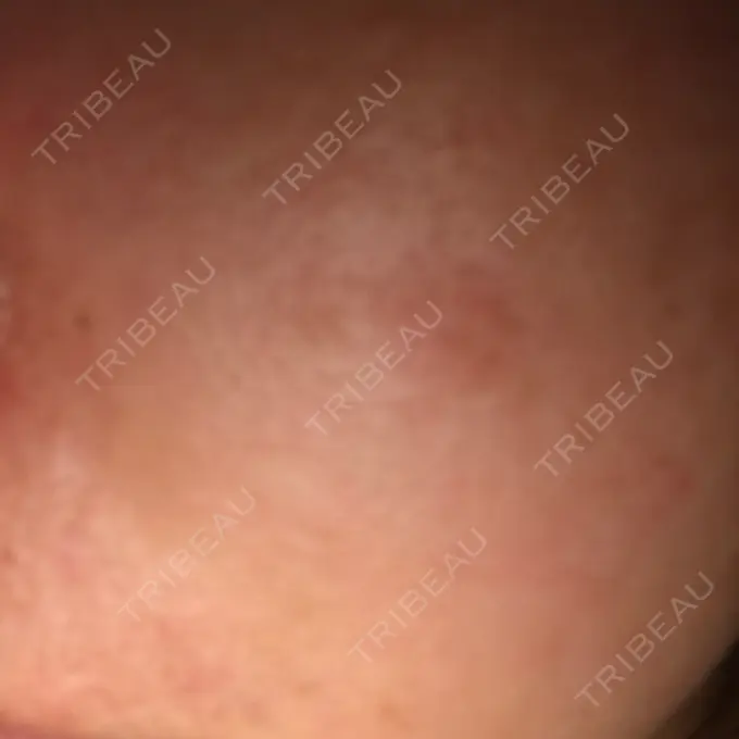 ダーマペン 湘南美容クリニック 武蔵小杉院 DAY 3 メイン用