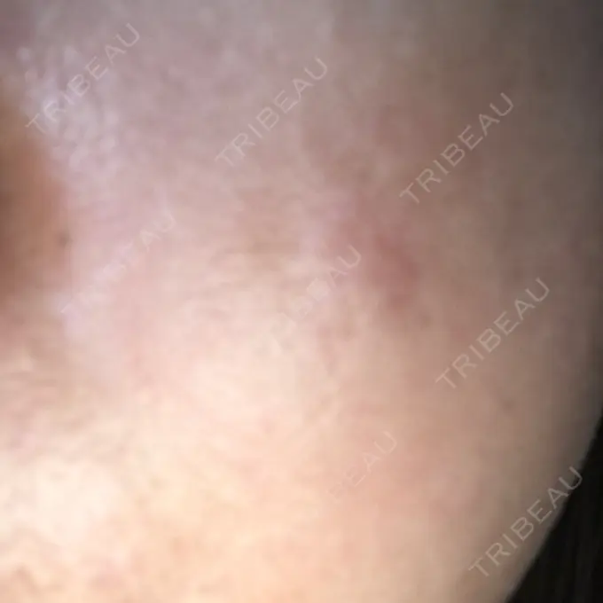 ダーマペン 湘南美容クリニック 武蔵小杉院 DAY 4 メイン用