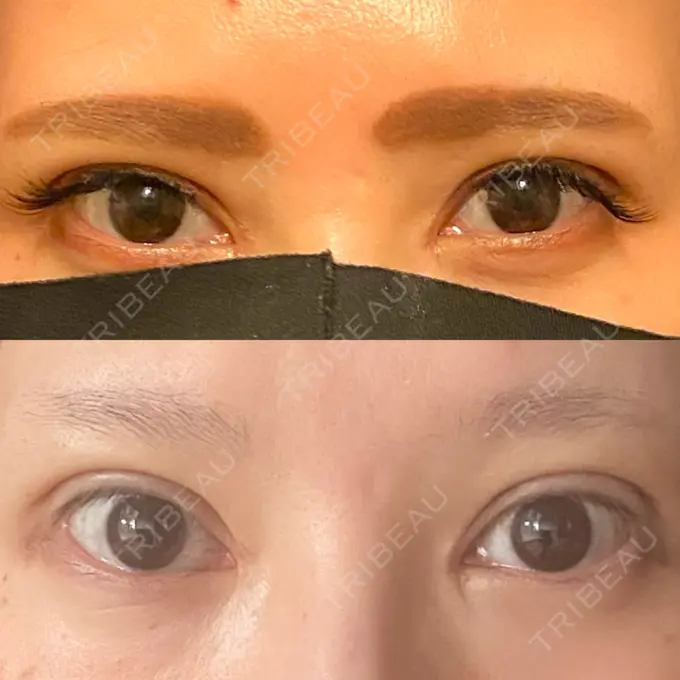 二重埋没 / 目頭切開 湘南メディカル記念病院（両国） DAY 35 メイン用